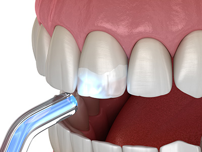 Mansfield Family Dentistry | Extractions, Dental Bonding and Inlays amp Onlays