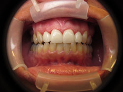 Mansfield Family Dentistry | Veneers, Emergency Treatment and Sedation Dentistry